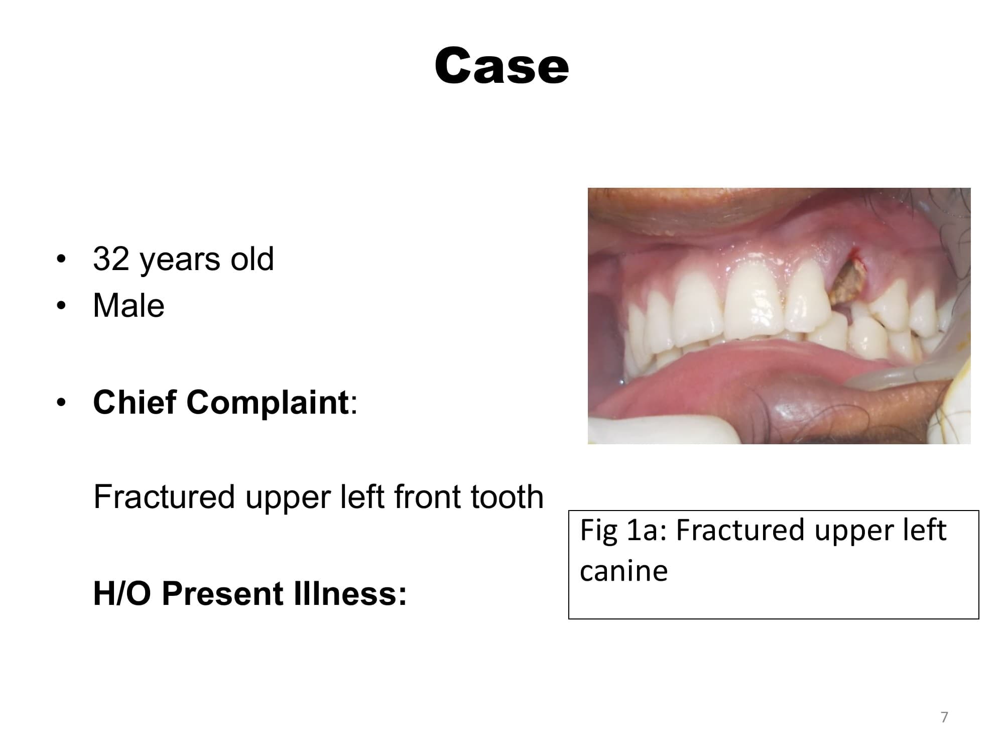 Immediate implant placement for fractured canine - before and after