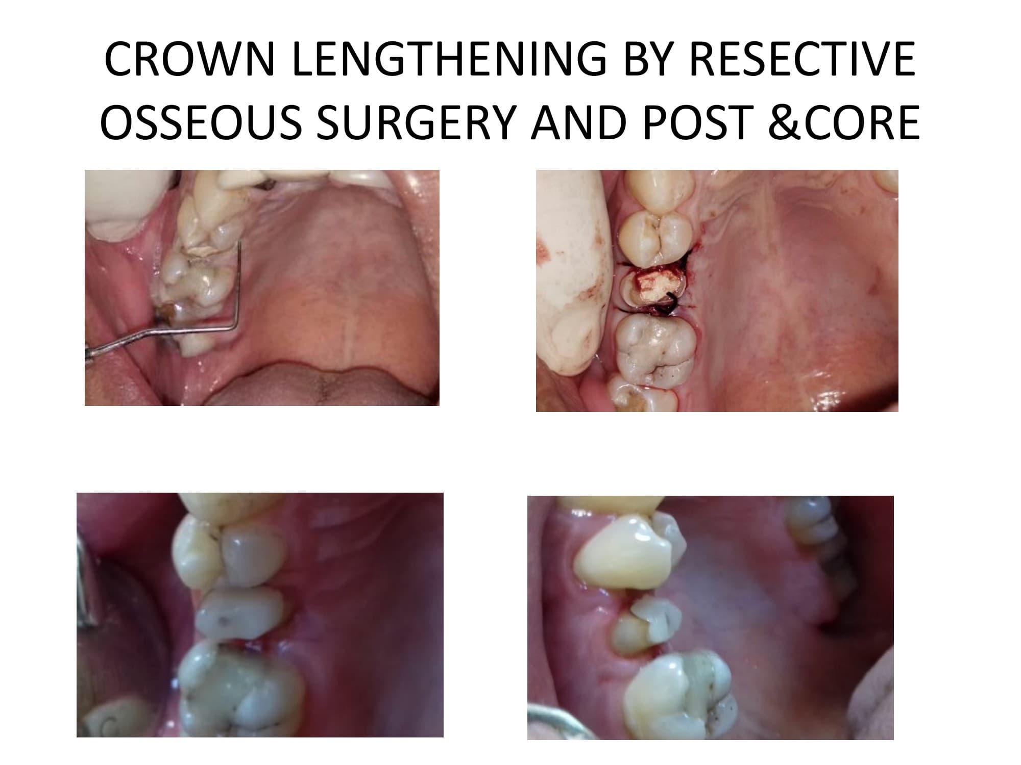 Crown lengthening surgery - before and after results