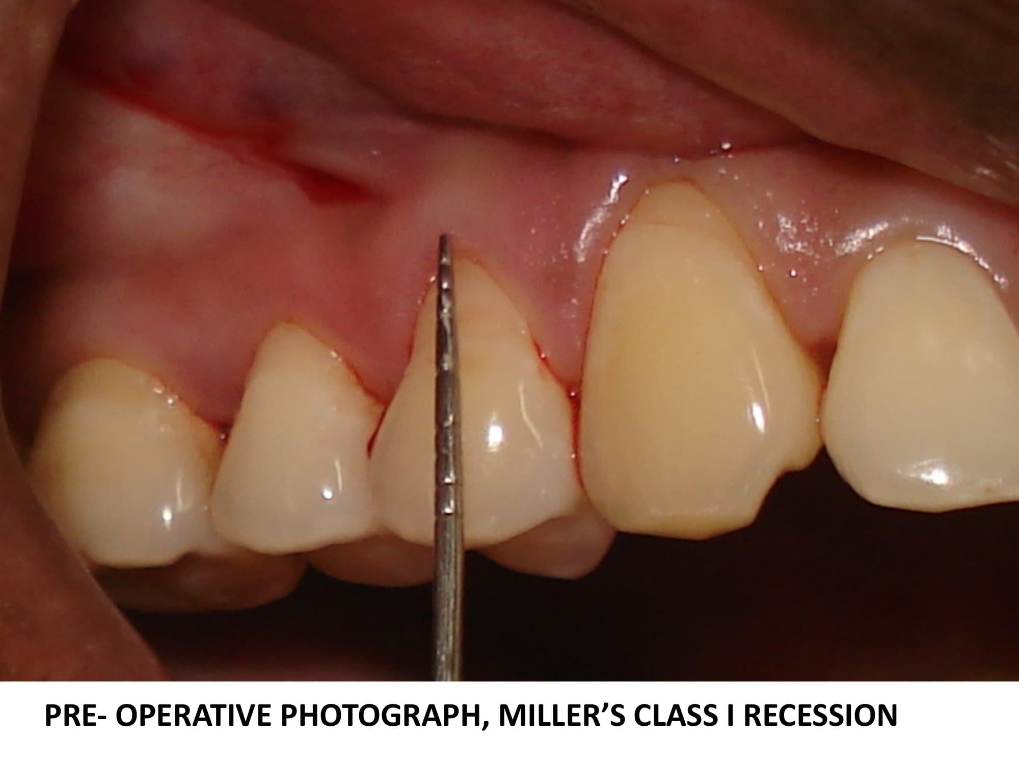 Gingival recession treatment - connective tissue graft results