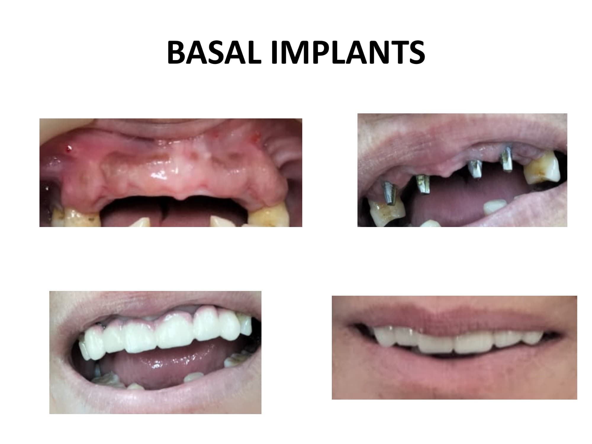 Basal implant cases - multiple teeth rehabilitation